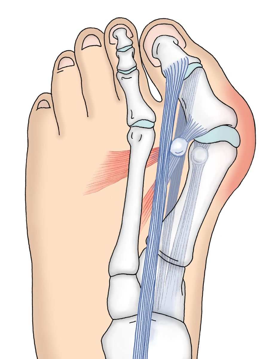 l-hallux-valgus-tiologie-biom-canique-et-approches-th-rapeutiques